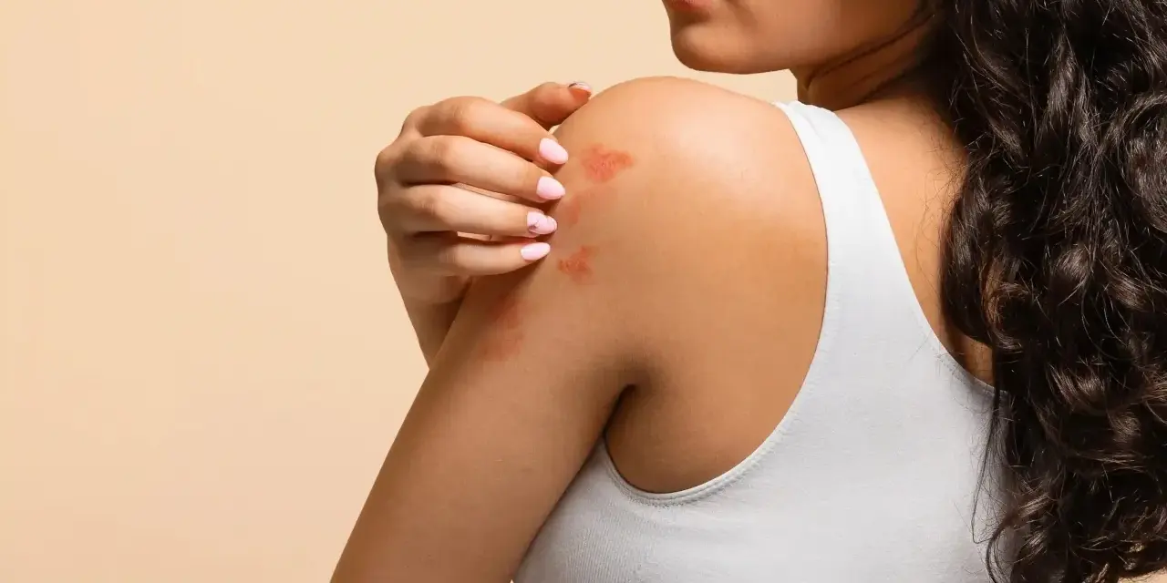 Éruption cutanée sur l'épaule d'une femme, possiblement une allergie soupline.