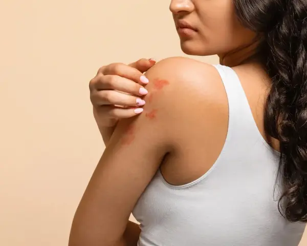 Éruption cutanée sur l'épaule d'une femme, possiblement une allergie soupline.