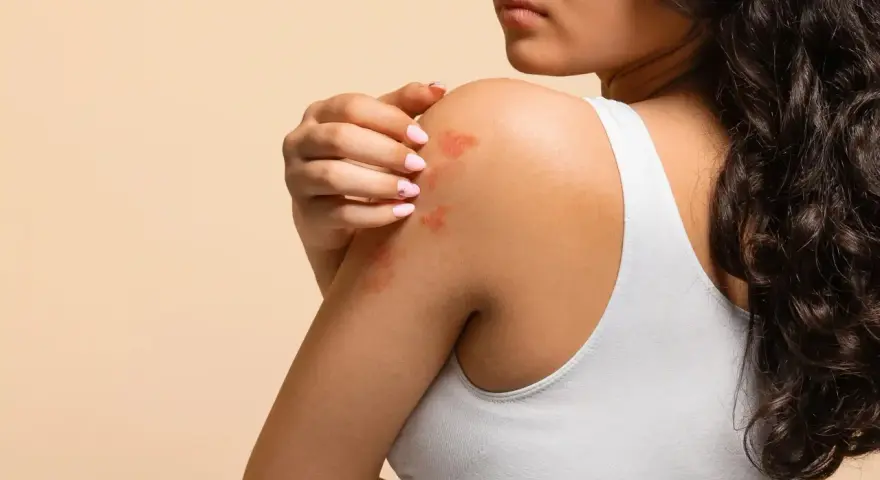 Éruption cutanée sur l'épaule d'une femme, possiblement une allergie soupline.
