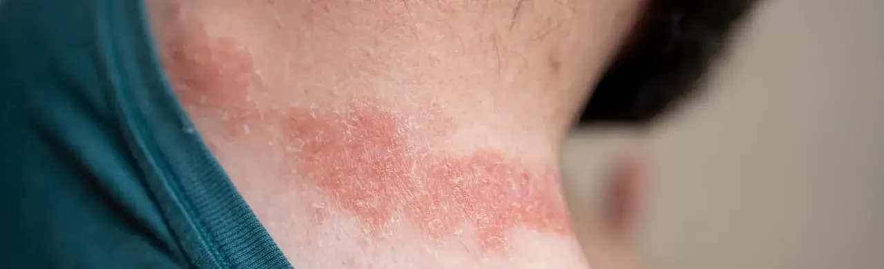 Irritation cutanée rouge et squameuse sur le cou, possiblement due à une allergie au Soupline.